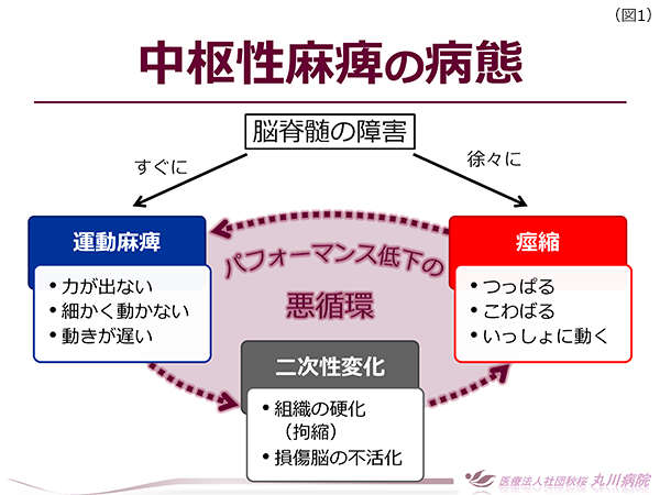 ボツリヌス療法とニューロリハビリテーション（ASSISTプログラム）